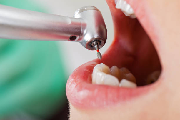 Best Emergency Tooth Extraction in Bedford, TX